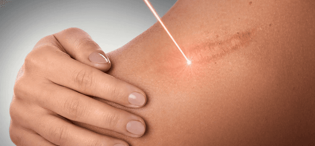 Scar Minimisation